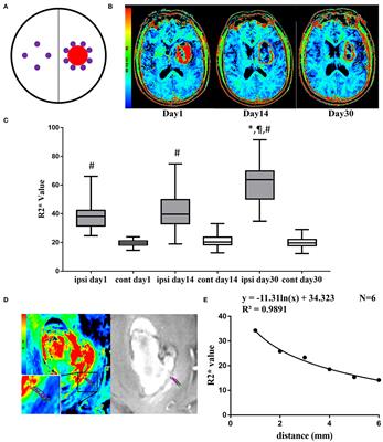 Association of Brain Iron Overload With Brain Edema and Brain Atrophy After Intracerebral Hemorrhage